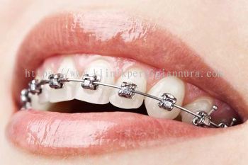 Self Ligating Braces - KLINIK PERGIGIAN NURA