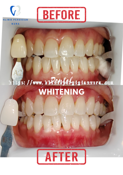 Dental Whitening