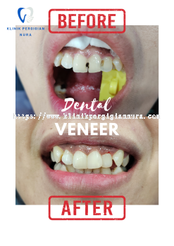 Composite Veneer