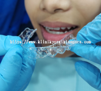 Essix Retainer ( Upper or Lower Only )