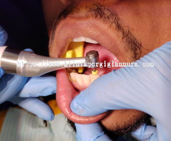 Root Canal Treatment (RCT)