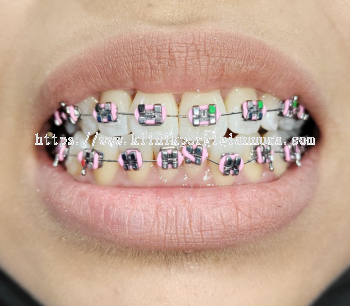 Conventional Braces - KLINIK PERGIGIAN NURA