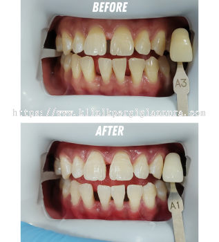 Beyond Whitening (3 cycle in one treatment)