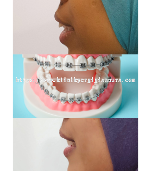 Braces (Installment Payment Method) - KLINIK PERGIGIAN NURA