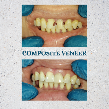 COMPOSITE VENEER