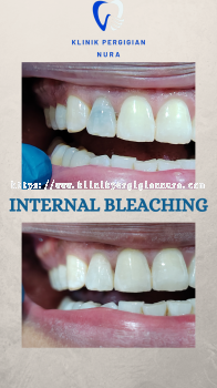 INTERNAL BLEACHING