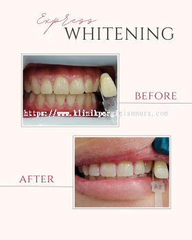 EXPRESS WHITENING