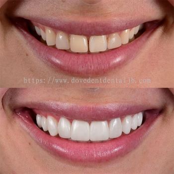 Veneer (Composite/Porcelain/Zirconia)