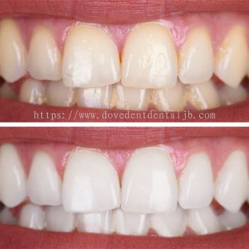 Express Teeth Whitening