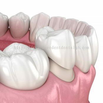 Crown & Bridge Teeth