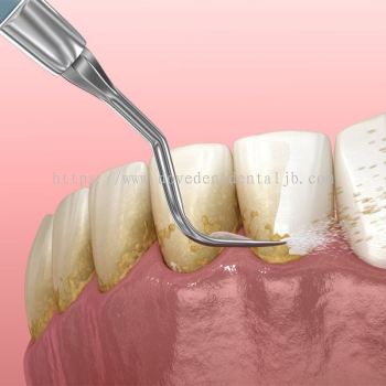 Tooth Scaling & Polishing