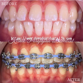 Braces Conventional