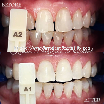 Express Teeth Whitening