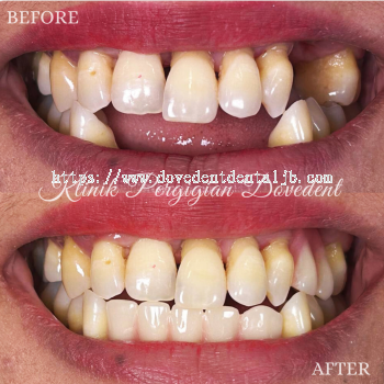 Removable Denture