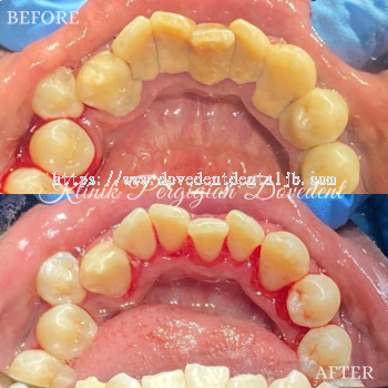 Tooth Scaling & Polishing