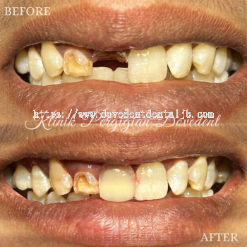 Removable Denture