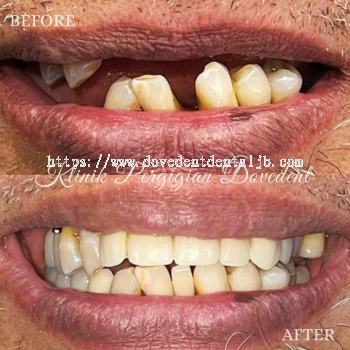 Removable Denture