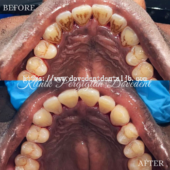 Teeth Scaling & Polishing