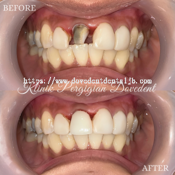 Crown Smile Makeover