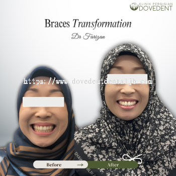 Transformation Braces