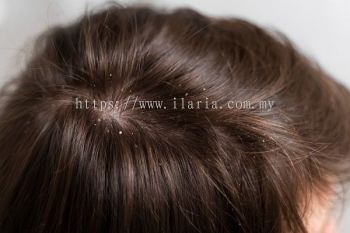 Severe Dandruff Solutions