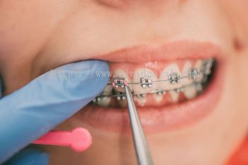 Braces Treatment