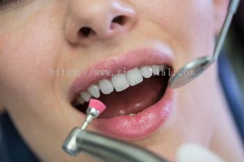 Flouride Varnish (Tooth Sensitivity Treatment)