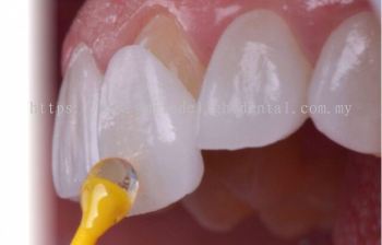 Dental Veneers