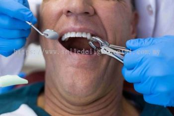 Tooth Extraction