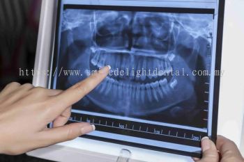 Dental X-Rays