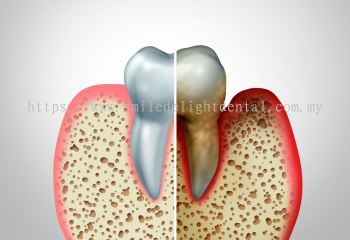 Periodontal Treatment