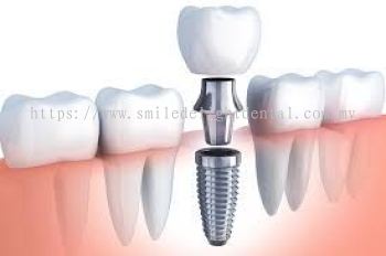 Dental Implant