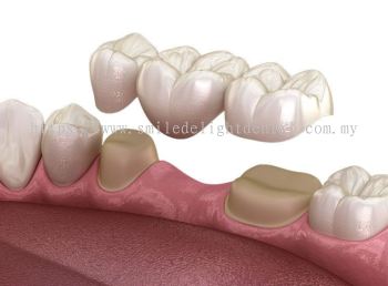 Dental Bridges