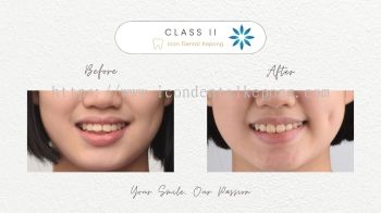 Invisalign