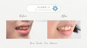 Invisalign