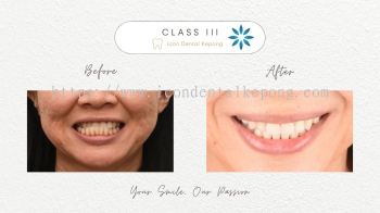 Invisalign