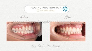 Invisalign