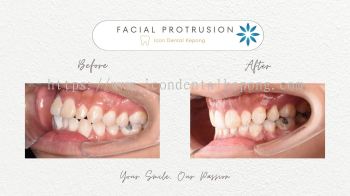 Invisalign