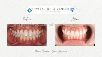 Invisalign