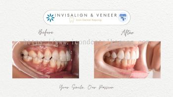 Invisalign