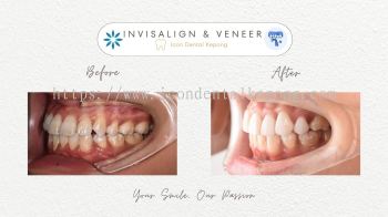 Invisalign