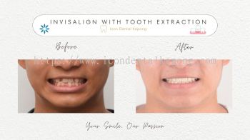Invisalign