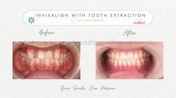 Invisalign