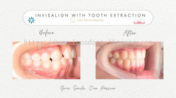 Invisalign