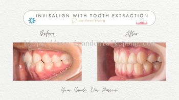 Invisalign