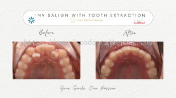 Invisalign