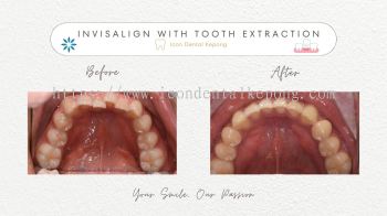 Invisalign