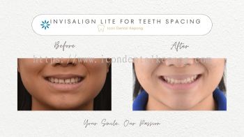 Invisalign