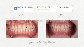 Invisalign