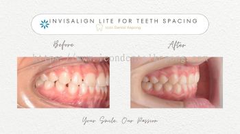 Invisalign